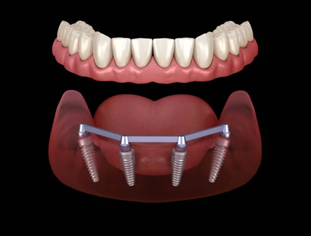 All-on-4 Dental Implants