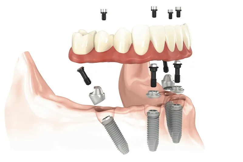 All-on-4 Dental Implants