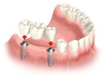 Mini Implants vs. Short Implants